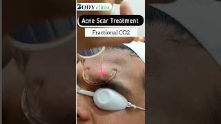 Effective Acne Scar Treatments at BodyClinix  Get Clearer Skin Today [upl. by Kele80]