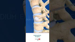 Spine Fracture Kyphoplasty ↪ 3D Medical Animation Shorts Kyphoplasty KyphoplastySurgery Spine [upl. by Murton]