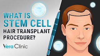 What Is Stem Cell hairtransplant Procedure stemcelltransplant [upl. by Nyrhtak578]