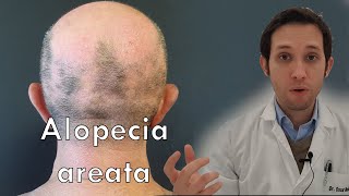 Alopecia areata qué debes hacer [upl. by Misa]