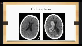 Intracerebral Hemorrhage  Neurology [upl. by Annet359]