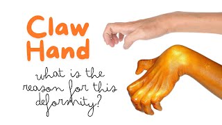 Claw hand is due to paralysis of what muscles Reason for clawing of hand handdeformity clawhand [upl. by Retsehc]