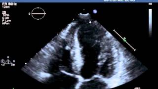 Transthoracic Echocardiographic Images Obtained after Cardiac Catheterization [upl. by Champaigne]