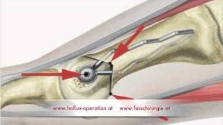 Hallux Operation nach Stoffella Teil 23 Osteotomie [upl. by Nnovahs]