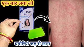 रात में लगा लो एक बार में ही घमौरियां जड़ से खत्म हो जाएंगी l kitchen tips l Heat rash prickly [upl. by Annovoj]