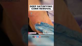 Deep satisfying corn removal  Miss Foot Fixer [upl. by Rus]