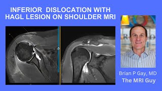 Inferior shoulder dislocation with HAGL lesion on MRI [upl. by Rossuck]