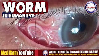 Ophthalmology  Worm in Human Eye Causes amp Extraction Process  Eye Parasite Removal [upl. by Seiber]