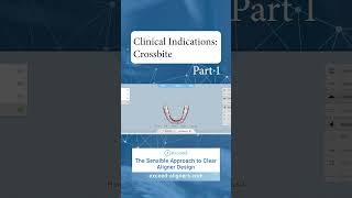 Clinical Indications Crossbite Part 1 [upl. by Boris]