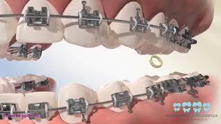 Posterior Crossbite Elastics [upl. by Eniawd]