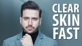 HOW TO GET CLEAR SKIN FAST  Mens Skincare Routine  ALEX COSTA [upl. by Ydnab63]