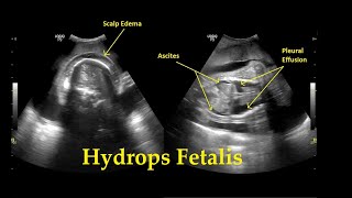 Hydrops Fetalis  Ultrasound  Anomaly  Case 26 [upl. by Aik]