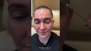 What Causes Crows Feet Botox with Dr Parsa Kami Parsa [upl. by Nwahsd870]