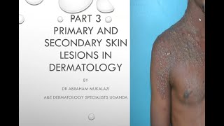 PRIMARY AND SECONDARY SKIN LESIONS CONFIGURATION AND DISTRIBUTION OF SKIN DISEASESeducation duet [upl. by Navanod]