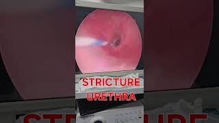 How stricture urethra look urethralstricturetreatment urethralstricture strictureurethra [upl. by Anauj]