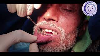 Fractured condyle of mandible  Dr Rajkumar R Choubey MDS  Dentist Ghazipur  Dentist Varanasi [upl. by Heid592]