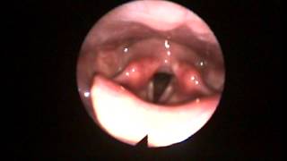 Nasendoscopy of constriction vs released voicing high to low pitch Sob to Twang [upl. by Rem]