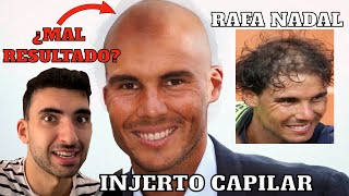 💥 ANÁLISIS del INJERTO CAPILAR de RAFA NADAL ❌  ¿MAL RESULTADO  Análisis Trasplantes 2 [upl. by Lauer392]