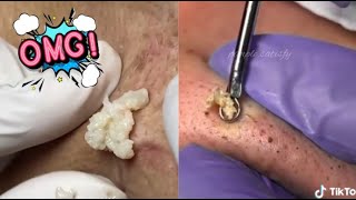 Satisfying Blackhead Removal Compilation 😍 Ultimate Skincare Satisfaction [upl. by Aicnelev]