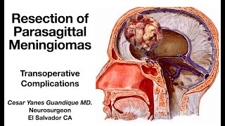 INTRAOPERATIVE COMPLICATIONS IN THE RESECTION OF PARASAGITTAL MENINGIOMAS [upl. by Mireielle197]