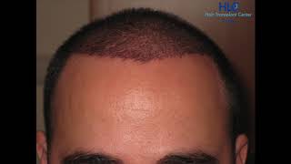 Hairforlife Kooperationsklinik HLC FUE Haartransplantation Türkei 2500 Grafts [upl. by Hareemas]