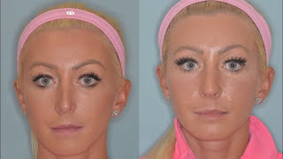 Revision Rhinoplasty for the OverProjected Nose  Dr Anthony Bared MD FACS Miami FL [upl. by Hagar]