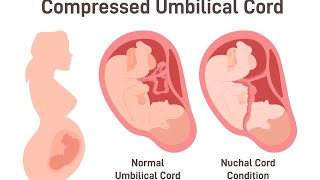 Was Your Baby’s HIE Brain Injury From A Nuchal Cord Preventable [upl. by Oderf]