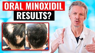 20000 PEOPLE TOOK ORAL MINOXIDIL AND THIS HAPPENED [upl. by Venus]