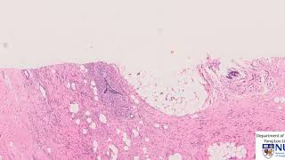 Morphology and prognosis of breast carcinoma [upl. by Madel]