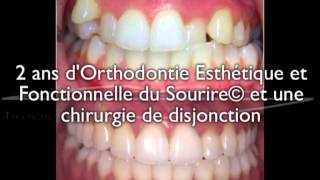 Disjonction chirurgicale jeune adulte  correction avec 2 ans daligneurs® en OEFS© sans extraction [upl. by Mcnutt]