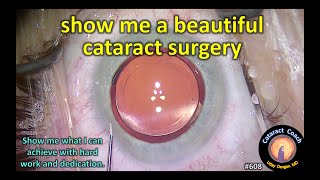 show me a beautiful cataract surgery [upl. by Lourdes]