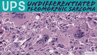 Undifferentiated Pleomorphic Sarcoma 101 UPS formerly malignant fibrous histiocytomaMFH [upl. by Akineg]