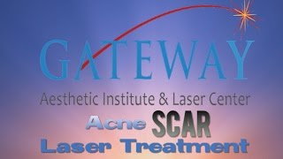 Acne Scar Laser Treatment  Gateway Aesthetics [upl. by Akiwak]