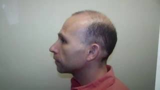 Dr Brett Bolton Hair Transplant Surgery Class 7 Patient Marius [upl. by Farica]