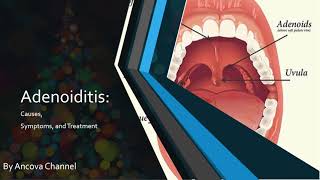 Adenoiditis PowerPoint presentation [upl. by Lionello]