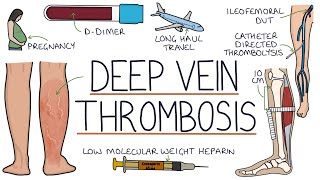 Understanding Deep Vein Thrombosis DVT [upl. by Lira]