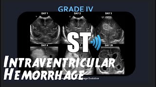 Intraventricular Hemorrhage Neonatal IVHBrain Bleed [upl. by Zeb]