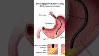 Esophagogastroduodenoscopy is a diagnostic endoscopic procedure gastroesophageal esophageal yt [upl. by Kuo]