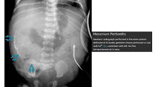 Meconium Peritonitis Imaging [upl. by Ritchie]