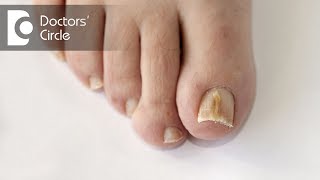 What are causes of vertical dark line on big toe  Dr Rajdeep Mysore [upl. by Anigue]