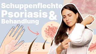 Schuppenflechte an der Kopfhaut beim Kind oder im Gesicht Wie behandeln│Dr med Alice Martin [upl. by Sharpe]