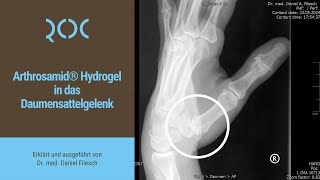 Arthrosamid® Hydrogel in das Daumensattelgelenk  ROC Aschheim [upl. by Gloria]