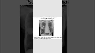 Pseudotumor signCHFradiology neetpg inicet shortsfeed [upl. by Nauhs]