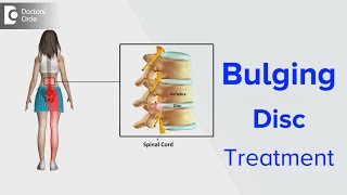 Bulging Disc Treatment  Dr Kodlady Surendra Shetty [upl. by Faline744]