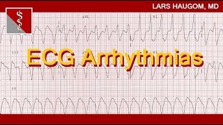 ECG Arrhythmias [upl. by Eylsel]