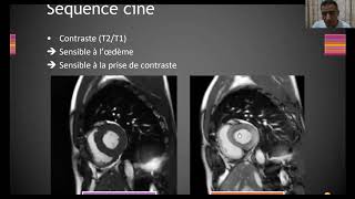 IRM cardiaque  Cardiopathie ischémique [upl. by Sonstrom]