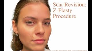 Scar Revision ZPlasty Procedure [upl. by Ileray265]