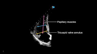 Measuring the right ventricle in echocardiography [upl. by Fillbert]