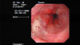 Band ligation for esophageal varices [upl. by Eenhpad]