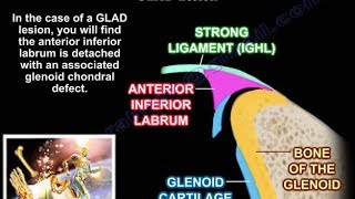 Lesions Of The Shoulder GLAD Lesion  Everything You Need To Know  Dr Nabil Ebraheim [upl. by Harutek]